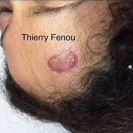 Cicatrice sur scalpe frontal avant