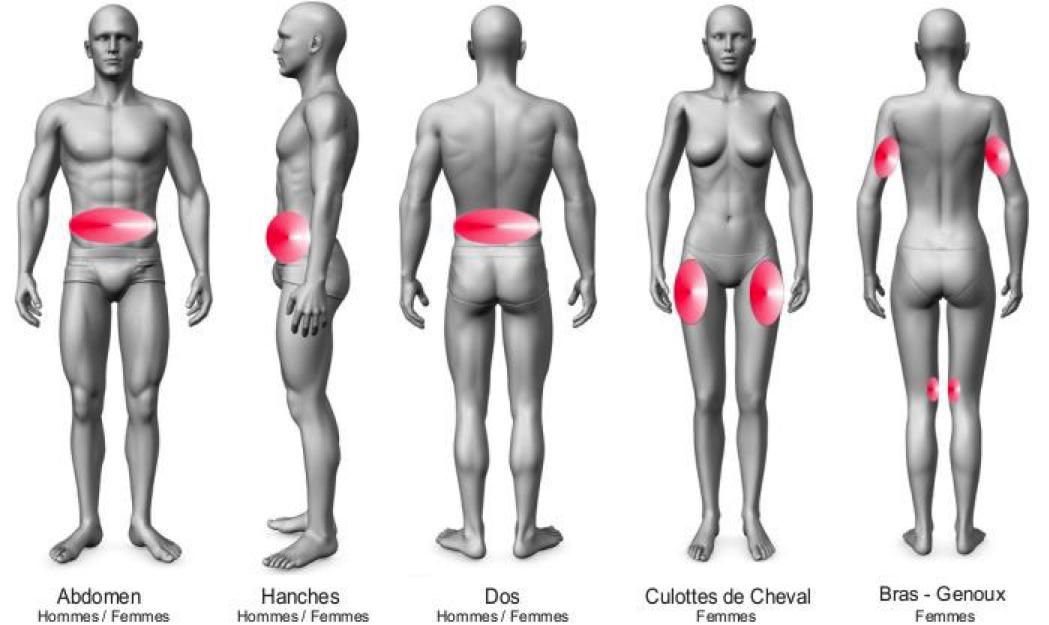 cryolipolyse