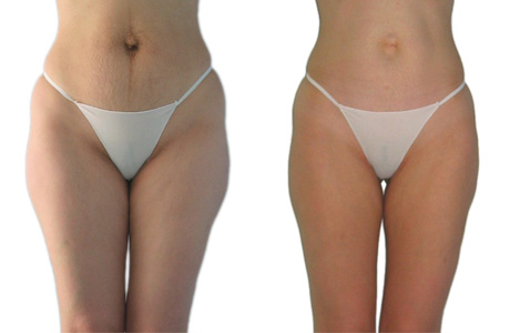 cellu m6 endermologie