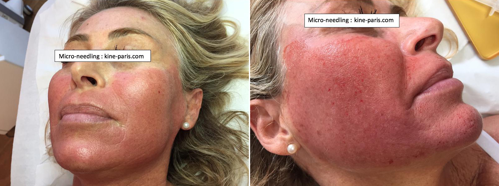 microneedling